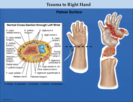 Trauma to Right Hand